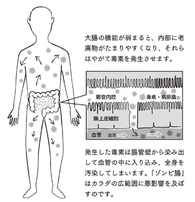 腸に老廃物が溜まり、全身の不調を引き起こすゾンビ腸