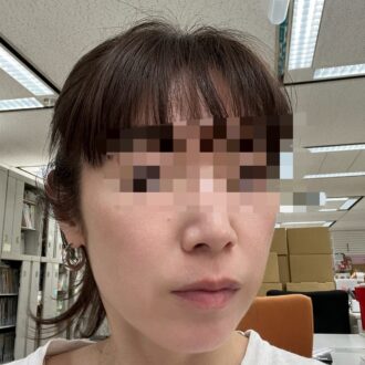 施術直後の肌