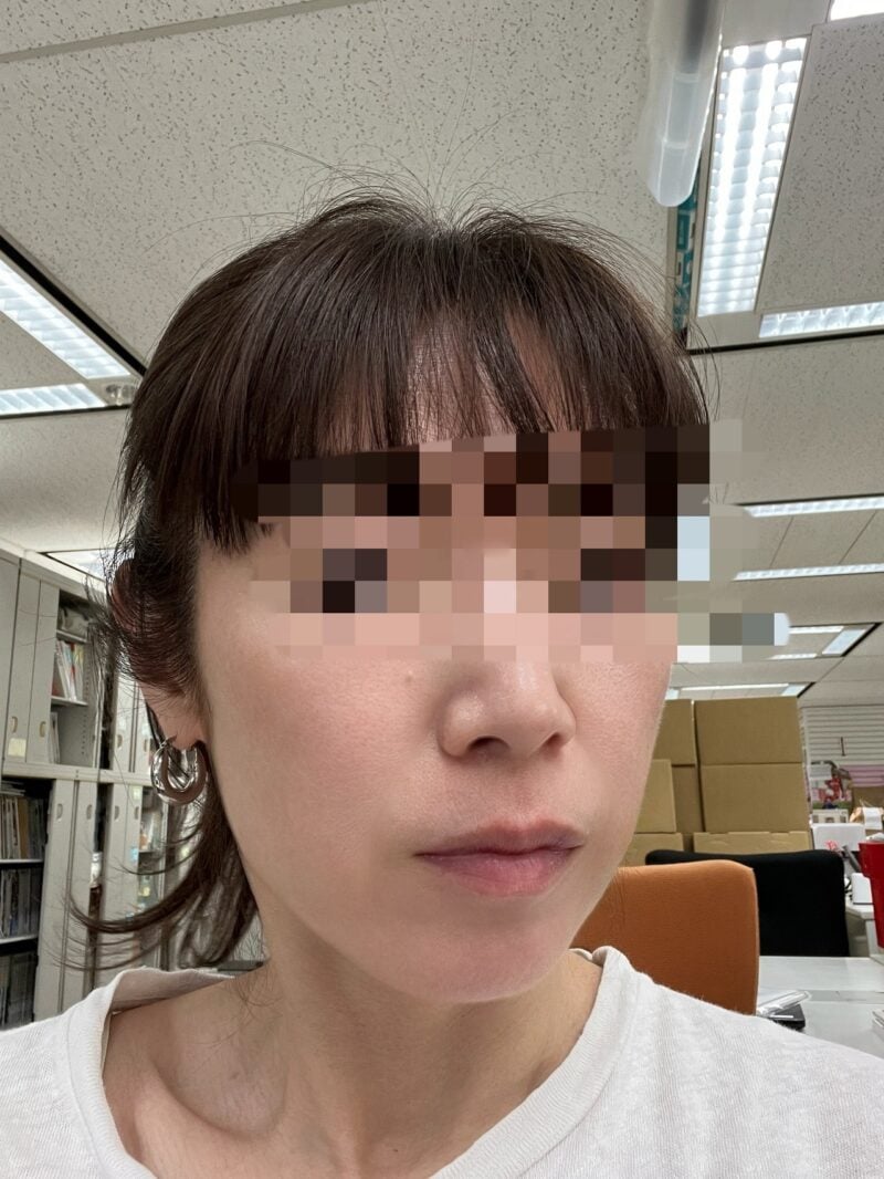 施術直後の肌
