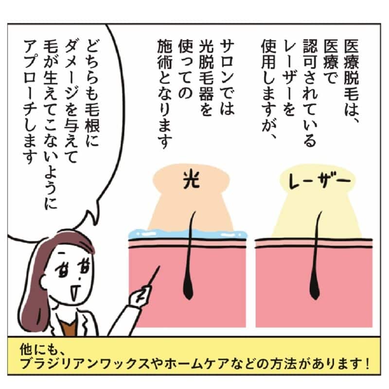 更年期のVIO脱毛　レーザーと光治療の解説