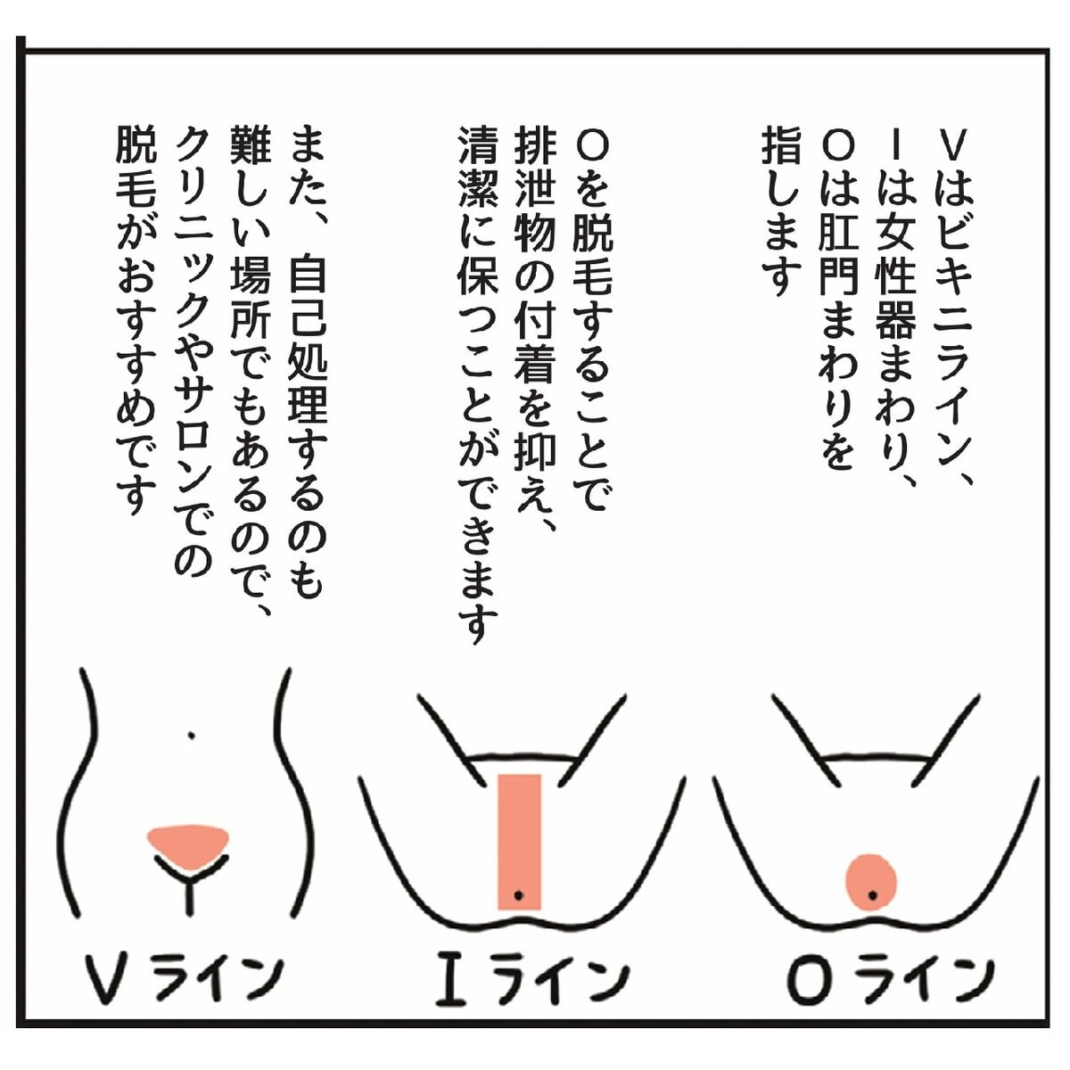 更年期のVIO脱毛タイプ