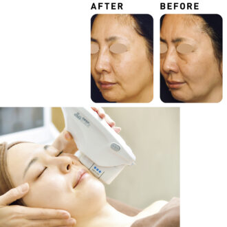 【40代美容】紫外線の少ない冬こそ“老け”対策！上級者さんにおすすめの本格美容医療3選｜before←afterつきレポ