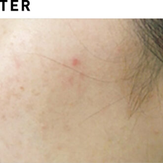 フォトフェイシャルStellar M22【AFTER】