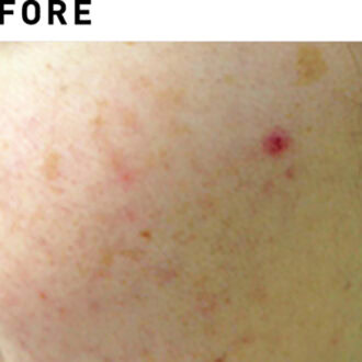 フォトフェイシャルStellar M22【BEFORE】