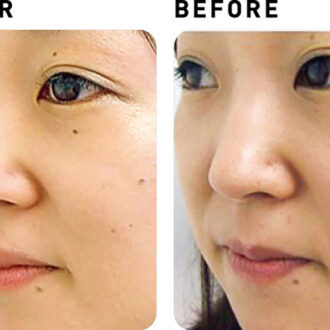 ウルトラ パルス アンコア【BEFORE&AFTER】