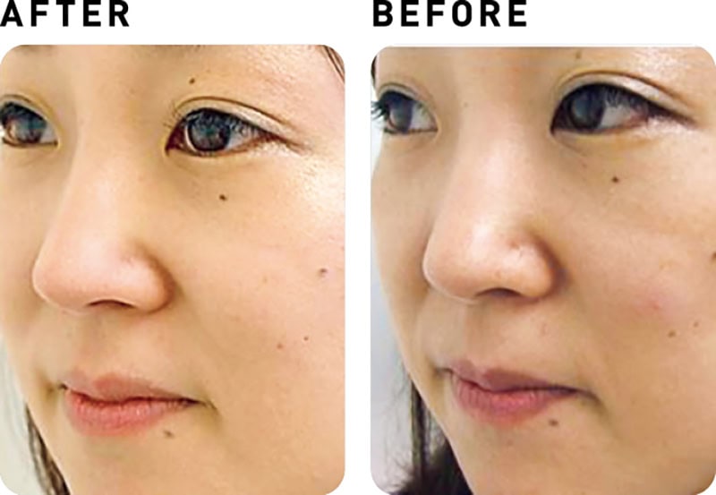 ウルトラ パルス アンコア【BEFORE&AFTER】