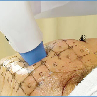 劇的な引き締め効果！しわとたるみの改善に。サーマクールCPT