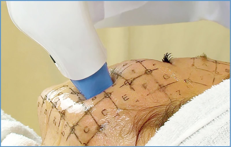 劇的な引き締め効果！しわとたるみの改善に。サーマクールCPT