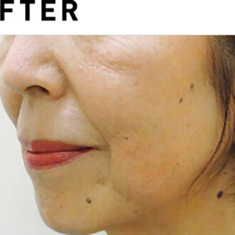 サーマクールCPT【AFTER】