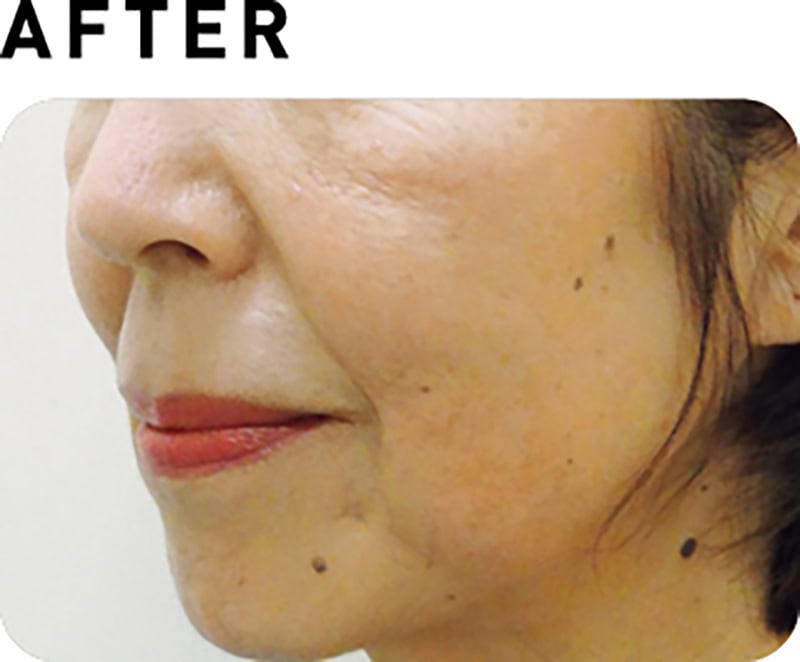 サーマクールCPT【AFTER】