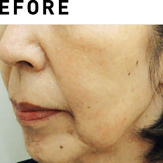 サーマクールCPT【BEFORE】