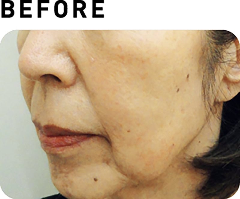 サーマクールCPT【BEFORE】