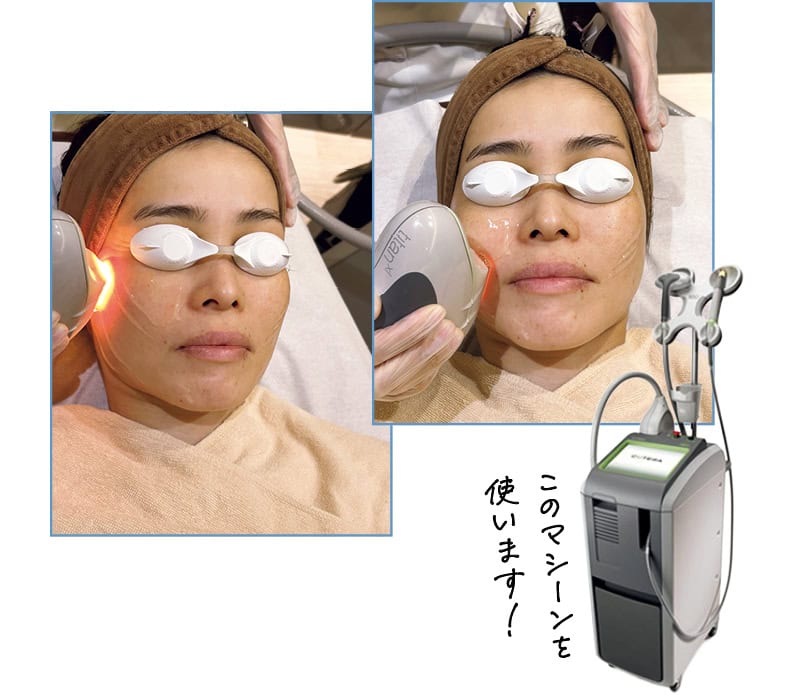 かがやき隊 高本有里子さんが美容医療 タイタンにトライ！