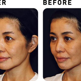 かがやき隊 高本有里子さんが美容医療 タイタンにトライ！【BEFORE&AFTER】