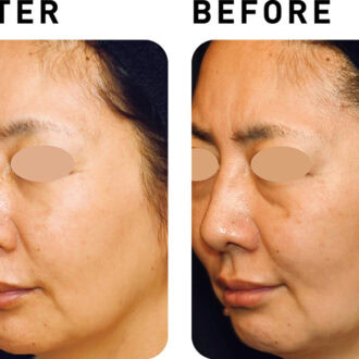 ウルセラ【BEFORE&AFTER】