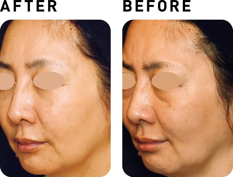 ウルセラ【BEFORE&AFTER】