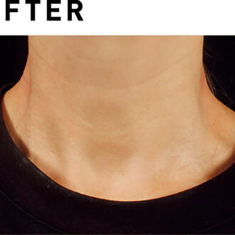 ソフウェーブ【AFTER】