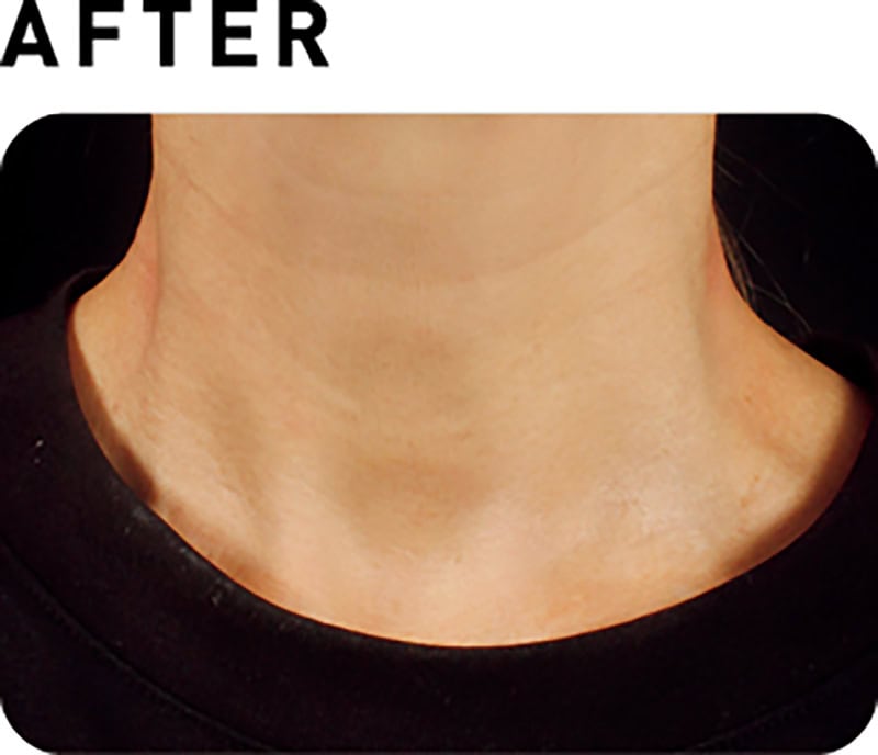 ソフウェーブ【AFTER】