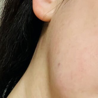 初回は「目立たない」を最優先、施術の流れや痛み