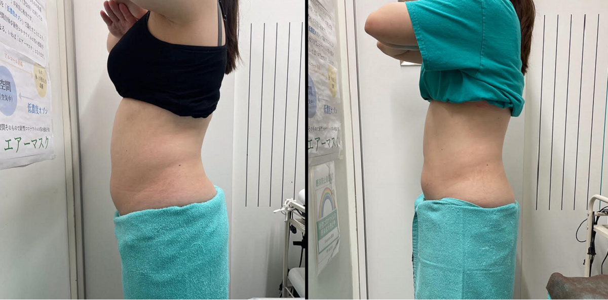 たった2回の施術でウエストー７cm!!