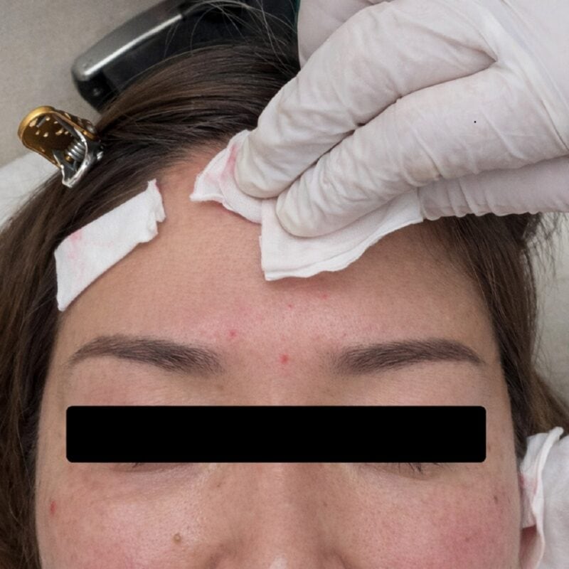 注射直後はすぐにコットンで止血